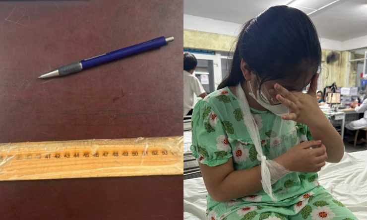 Thực hư vụ việc cô giáo ở Huế "đánh gãy tay" học sinh lớp 4 - 2