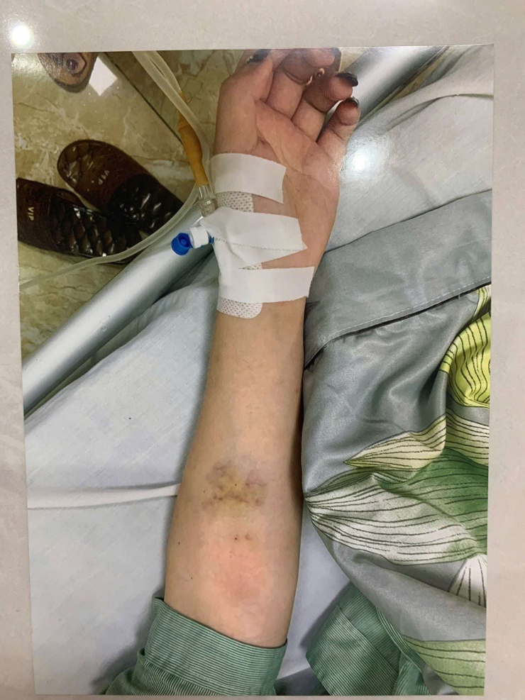 Nữ sinh được đưa vào bệnh viện kiểm tra với nhiều vết bầm tím ở mặt và tay. Ảnh: CMH