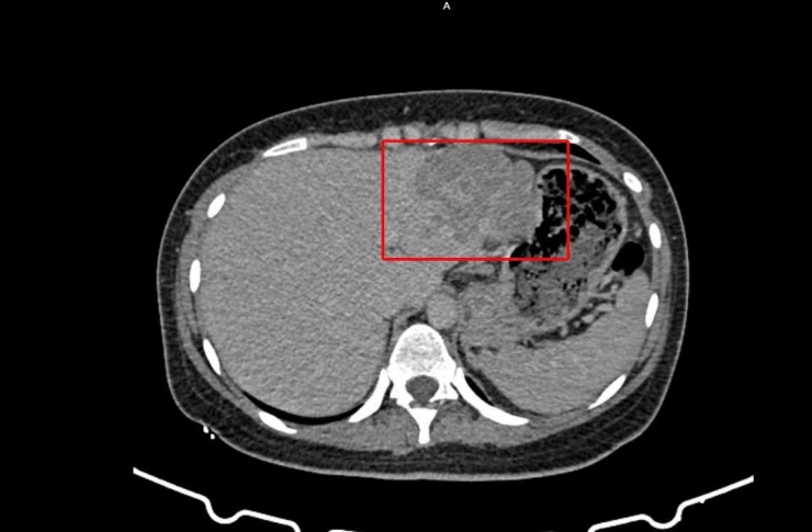 Vùng gan bị tổn thương trên hình ảnh kiểm tra được các bác sĩ ghi nhận