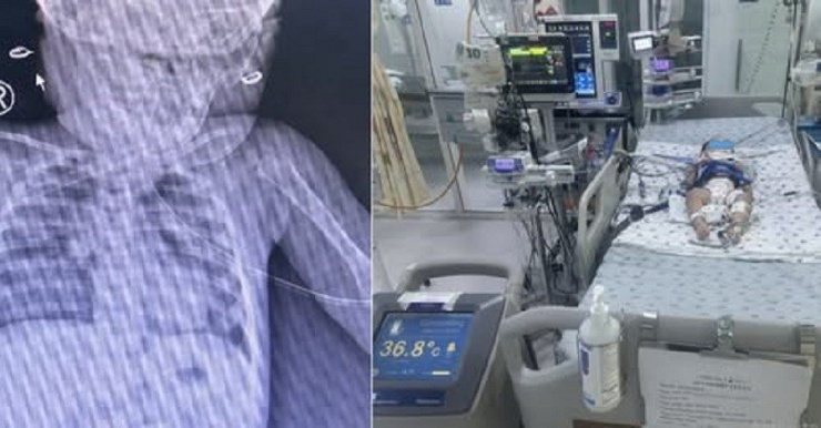 Bệnh nhi được điều trị tích cực tại Bệnh viện Nhi Đồng Thành phố