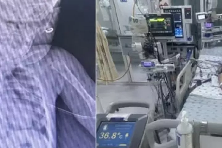 Bé gái mới biết đi bị ngã vào thùng nước khiến ngưng tim ngưng thở