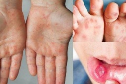 Bệnh tay chân miệng tăng nhanh, xuất hiện chủng nguy hiểm: Cha mẹ cần làm gì để bảo vệ trẻ?