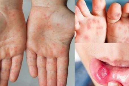 Bệnh tay chân miệng tăng nhanh, xuất hiện chủng nguy hiểm: Cha mẹ cần làm gì để bảo vệ trẻ?