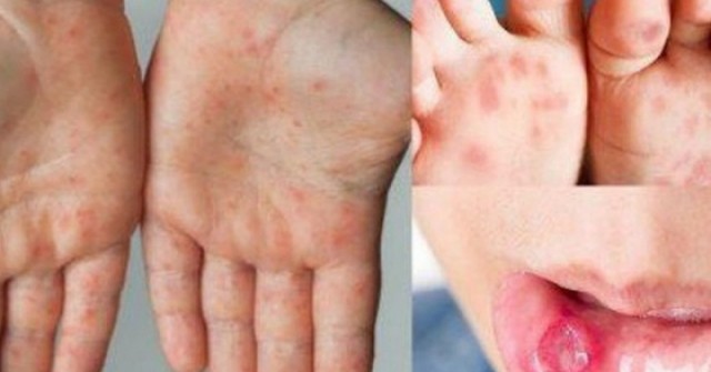 Bệnh tay chân miệng tăng nhanh, xuất hiện chủng nguy hiểm: Cha mẹ cần làm gì để bảo vệ trẻ?