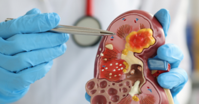 Loại rau ngon bổ nhưng tăng gánh nặng cho thận, người bệnh suy thận cần biết để tránh