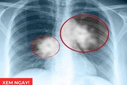 Tin tức sức khỏe - Tư thế ngủ tốt nhất cho phổi giúp giảm đàm ho, thở dễ hơn: Nhiều người đang làm sai!