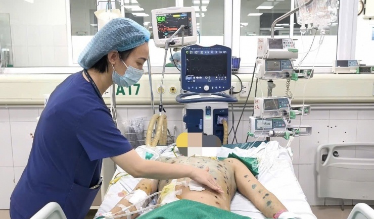 Bệnh nhân diễn biến rất nặng do bệnh thuỷ đậu.