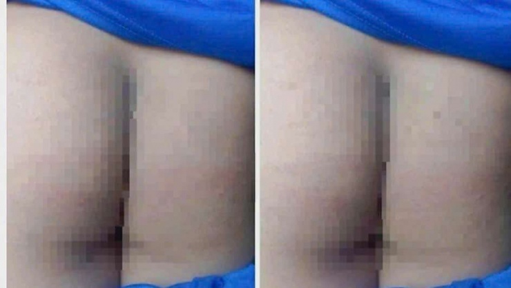 Trên mông của em H. để lại vết roi do phải chịu hình phạt theo "giao kèo". Ảnh: CTV