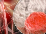 Người đàn ông mắc ung thư thực quản thừa nhận 2 sai lầm nhiều người Việt mắc phải