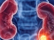 Người đàn ông bất ngờ phát hiện mắc ung thư thận từ dấu hiệu nhiều người Việt bỏ qua