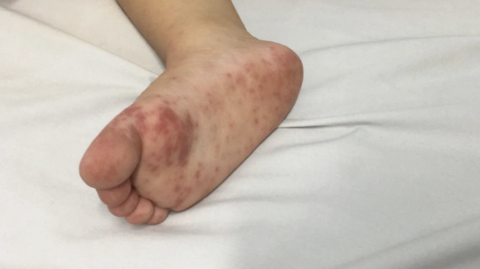 Các bác sĩ khuyến cáo khi trẻ có dấu hiệu sốt, bỏ ăn, chảy nước miếng, nổi ban hoặc bóng nước..., cha mẹ cần đưa đi khám sớm để được chẩn đoán và xử lý kịp thời.