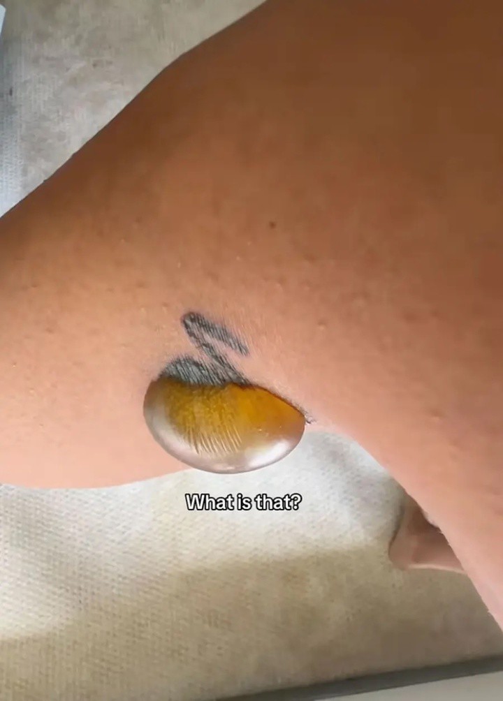 Các chuyên gia cho biết những vết phồng rộp như của Green khá phổ biến sau khi xóa hình xăm bằng laser.