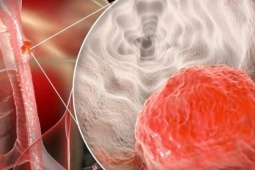 Người đàn ông mắc ung thư thực quản thừa nhận 2 sai lầm nhiều người Việt mắc phải