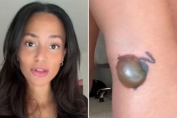 KOL hoảng sợ 'cầu cứu' khi gặp biến chứng 'kinh khủng' sau xóa hình xăm