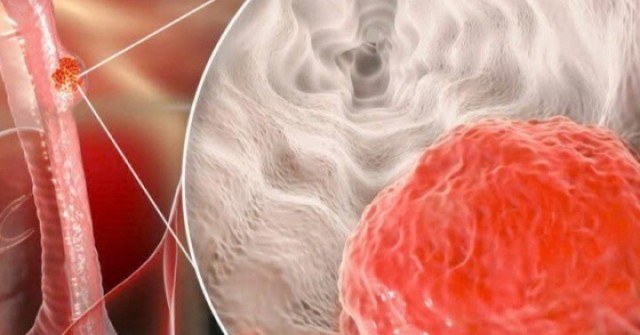 Người đàn ông mắc ung thư thực quản thừa nhận 2 sai lầm nhiều người Việt mắc phải