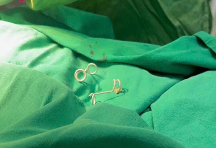 Ít ai biết rằng, chính “đôi cánh” ấy đã giúp em đi qua giai đoạn mong manh nhất của sự sống, để có thể ở lại trong bụng mẹ thêm từng ngày và chờ đến khoảnh khắc được chào đời. Ảnh: BVCC