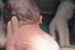 Khoảnh khắc chào đời đặc biệt: Em bé sinh ra với "đôi cánh nhỏ" trên lưng