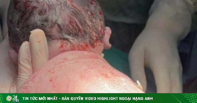 Khoảnh khắc chào đời đặc biệt: Em bé sinh ra với "đôi cánh nhỏ" trên lưng