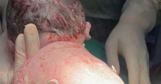 Khoảnh khắc chào đời đặc biệt: Em bé sinh ra với "đôi cánh nhỏ" trên lưng