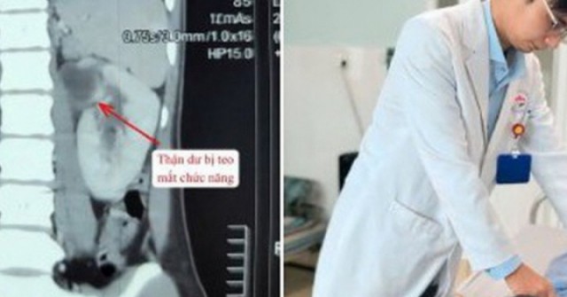 Cô gái 22 tuổi mất chức năng thận vì dị tật hiếm, bác sĩ cảnh báo dấu hiệu dễ bỏ qua