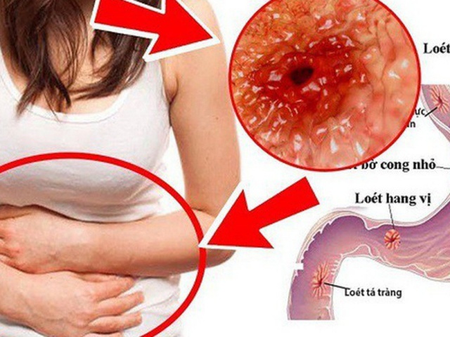 Cô gái 23 tuổi phát hiện mắc ung thư dạ dày từ dấu hiệu nhiều người Việt bỏ qua