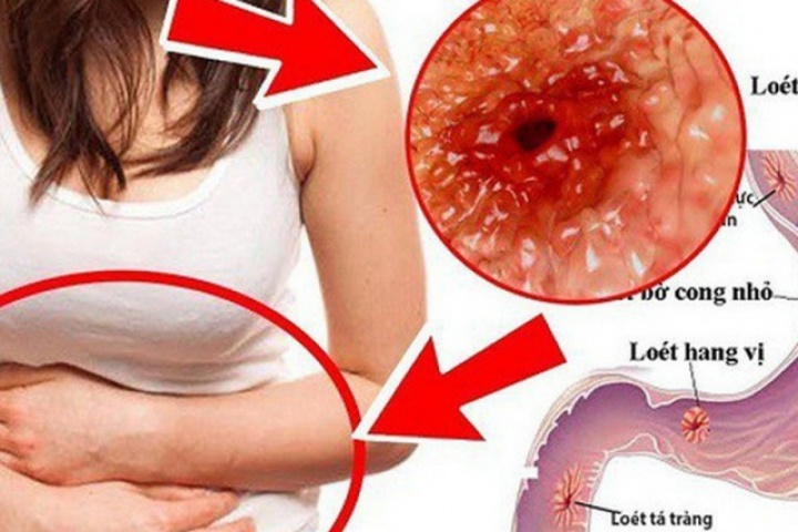 Cô gái 23 tuổi phát hiện mắc ung thư dạ dày từ dấu hiệu nhiều người Việt bỏ qua