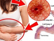 Cô gái 23 tuổi phát hiện mắc ung thư dạ dày từ dấu hiệu nhiều người Việt bỏ qua