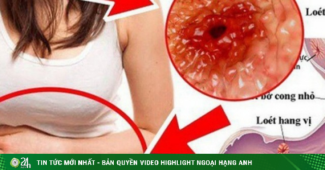 Cô gái 23 tuổi phát hiện mắc ung thư dạ dày từ dấu hiệu nhiều người Việt bỏ qua