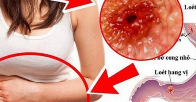 Cô gái 23 tuổi phát hiện mắc ung thư dạ dày từ dấu hiệu nhiều người Việt bỏ qua