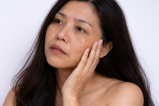 Chế độ ăn thiếu hụt dưỡng chất khiến da khô, xỉn màu, lão hóa sớm.