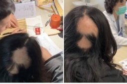 Hi hữu mẹ rụng tóc từng mảng vì áp lực thức khuya dạy con học