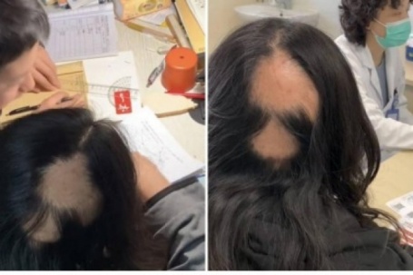 Hi hữu mẹ rụng tóc từng mảng vì áp lực thức khuya dạy con học