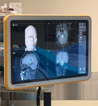 Hệ thống định vị KICK Navigation System (Brainlab) dựng mô hình cấu trúc não dưới dạng 3D. Ảnh: FV