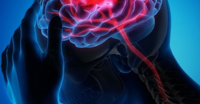 Nghiên cứu 53.000 người chỉ ra 3 cách ngăn ngừa đột quỵ đơn giản