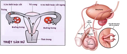 Triệt sản rồi bỗng có con trở lại - 1