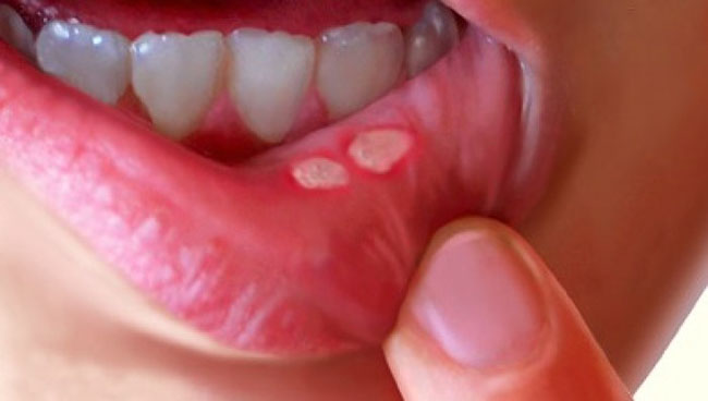 12 cách chữa căn bệnh nhiệt miệng đáng ghét - 1