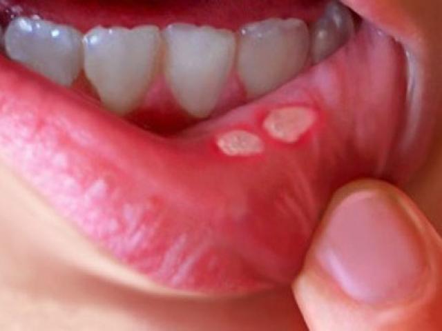 12 cách chữa căn bệnh nhiệt miệng đáng ghét