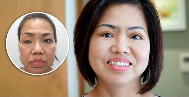 Nữ Việt kiều hồi hương cứu đôi mắt hơn 60 năm sụp mi - 1