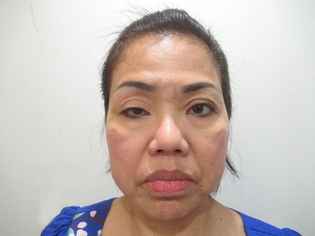 Nữ Việt kiều hồi hương cứu đôi mắt hơn 60 năm sụp mi - 2