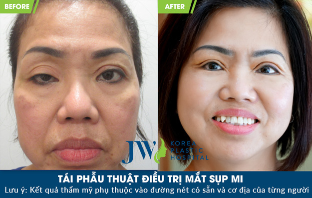 Nữ Việt kiều hồi hương cứu đôi mắt hơn 60 năm sụp mi - 3