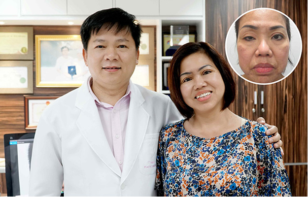 Nữ Việt kiều hồi hương cứu đôi mắt hơn 60 năm sụp mi - 4