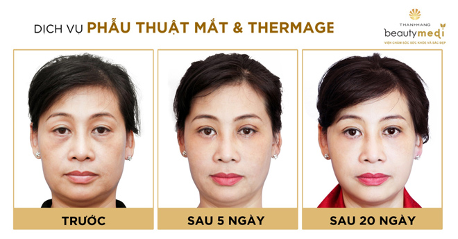 Mẹ chồng quyết trẻ hóa đôi mắt để đón con dâu xinh - 4