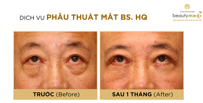 Mẹ chồng quyết trẻ hóa đôi mắt để đón con dâu xinh - 6