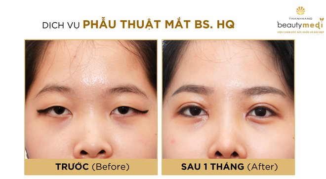 Mẹ chồng quyết trẻ hóa đôi mắt để đón con dâu xinh - 7