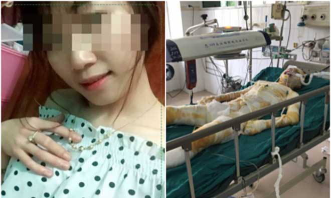 Cô gái bị bạn trai đổ xăng vào người thiêu đã tử vong - 1