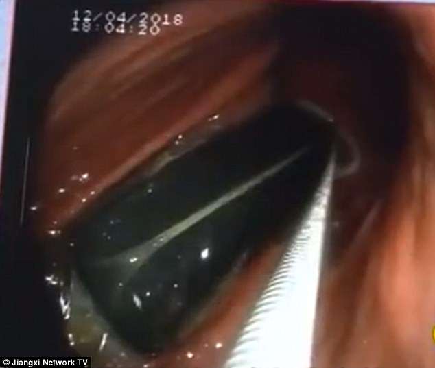 Đau dữ dội, vào viện khám thấy bật lửa nằm trong bụng 20 năm - 2