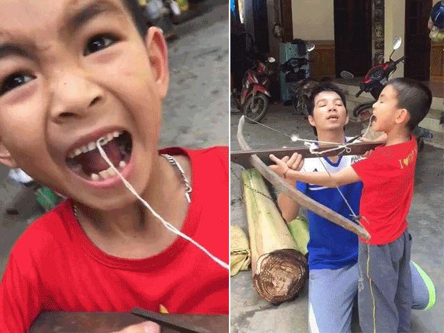 Bạn trẻ - Cuộc sống - Đỉnh cao nhổ răng cho con của những ông bố Việt