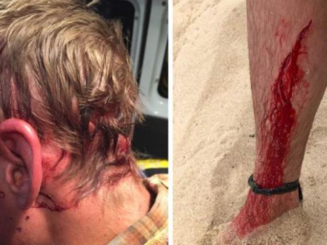 Thế giới - Bị rắn độc, gấu và cá mập cắn, thanh niên Mỹ vẫn sống phi thường