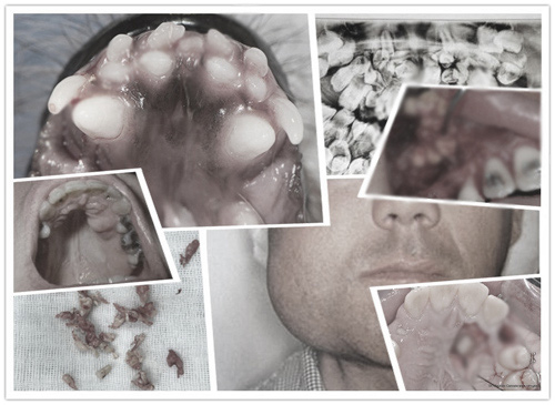 Ám ảnh kinh hoàng từ căn bệnh U răng hiếm gặp tại Việt Nam - 1