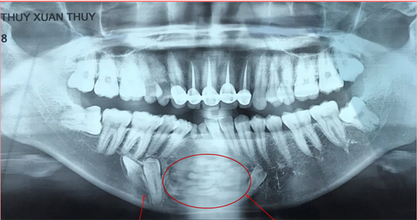 Ám ảnh kinh hoàng từ căn bệnh U răng hiếm gặp tại Việt Nam - 2